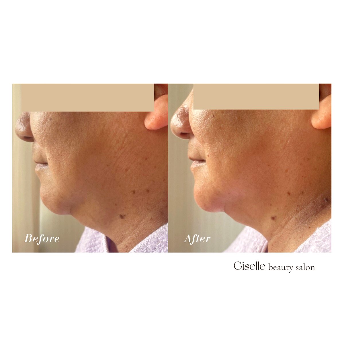 プレミアムケア ビフォーアフター 毛穴・肌質改善